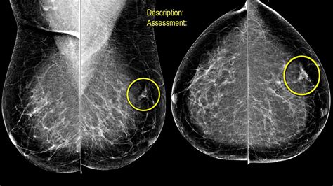 what is spot compression mammogram